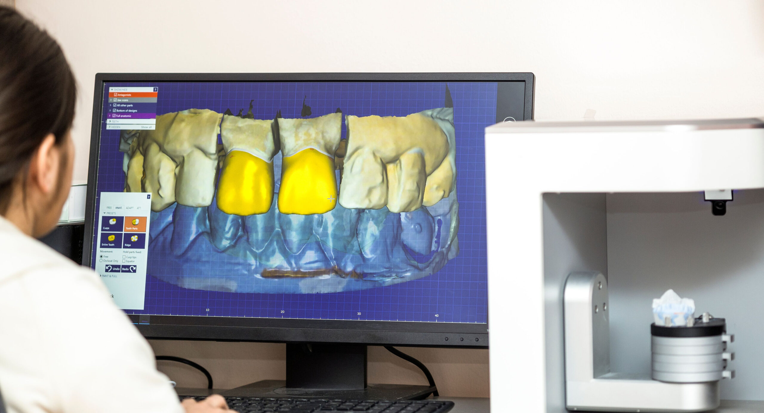 Digital dental design